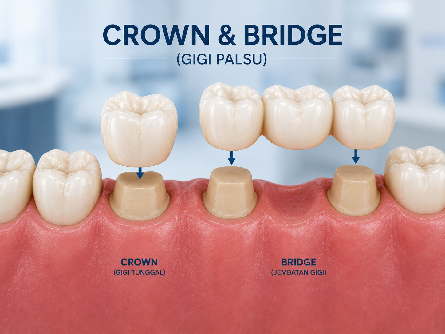 Gigi Palsu, Crown & Bridge